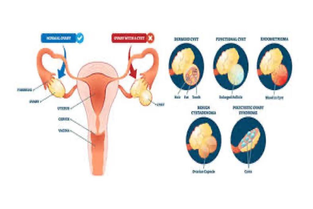 Ovarian Cyst Operations: Open and Laparoscopic Approach